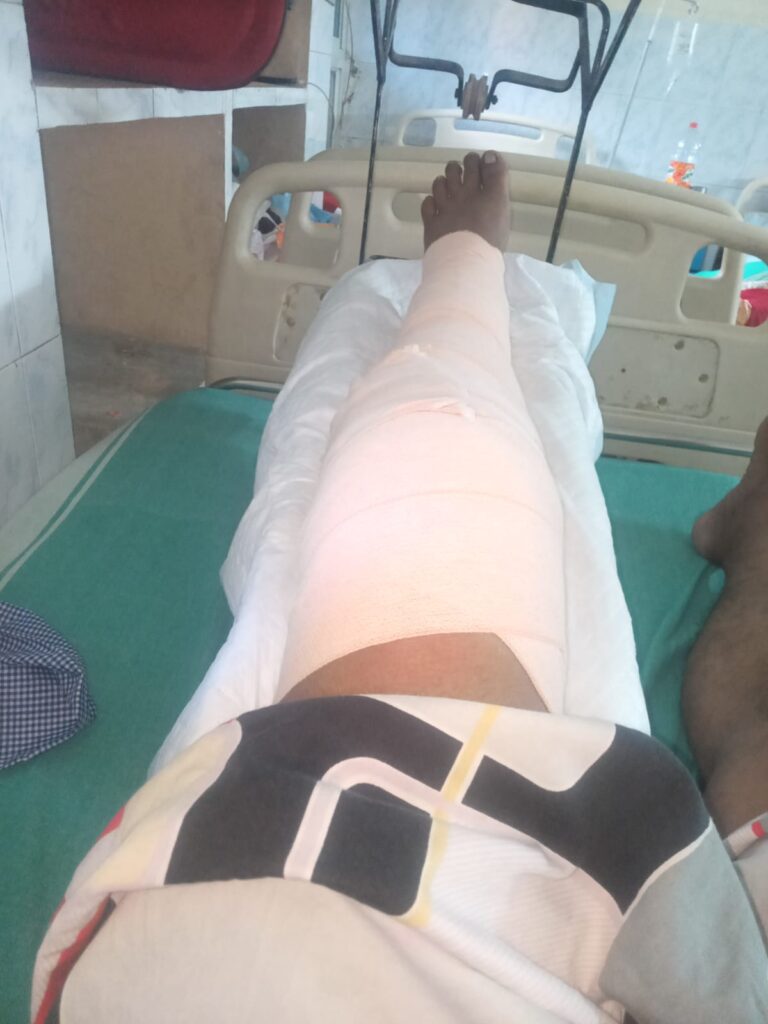Road Accident in Singrauli - बुलेट सवार पंप संचालक को बोलेरो ने मारी टक्कर, बाया पैर टूटा, बनारस रेफर