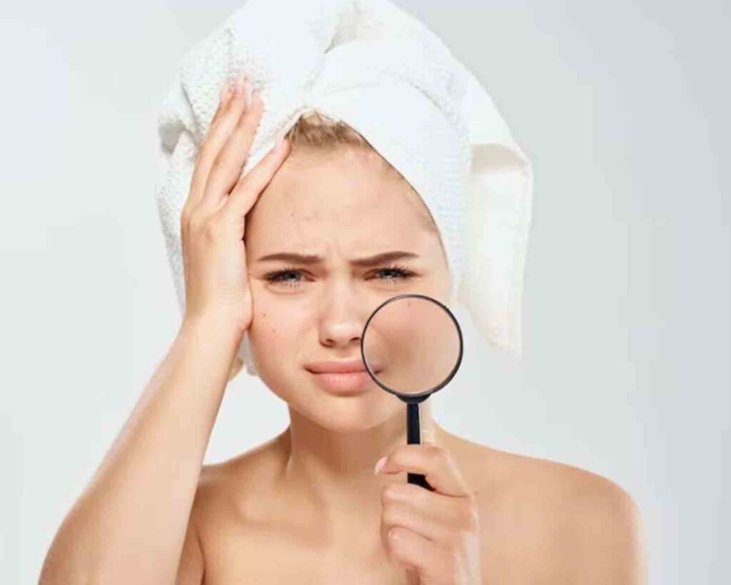 Skin caring : पिम्पल की समस्या से है परेसान तो इन चीजों अपने स्किन केयर में करें शामिल,खिल उठेगा चेहरा