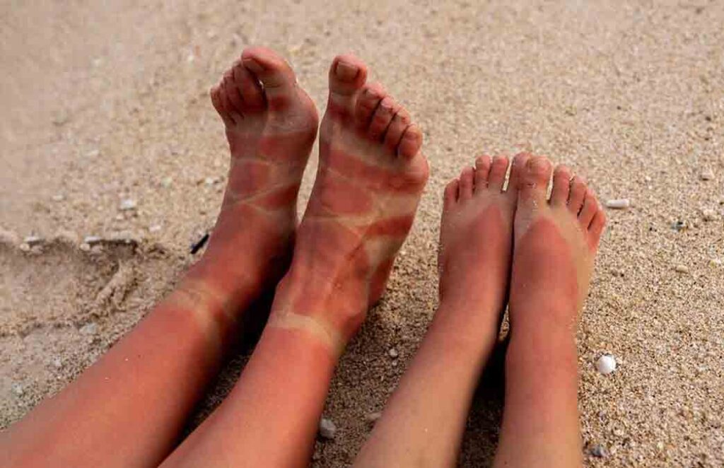 Tanning Remove : पैर के पंजों पर होने वाली टैनिंग को रिमूव करने के लिए आजमाए ये आसान नुस्खे